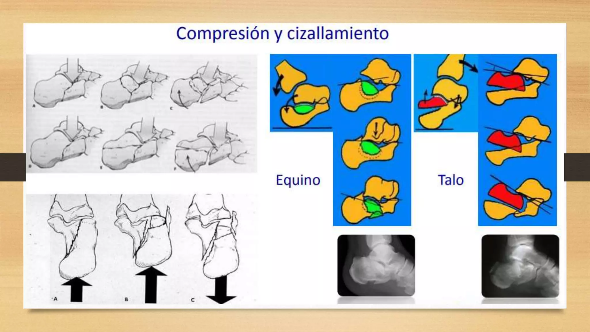 Fractura de calcaneo | PPTX