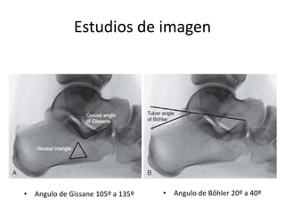 Estudios de imagen
• Angulo de Gissane 105º a 135º • Angulo de Bôhler 20º a 40º
 