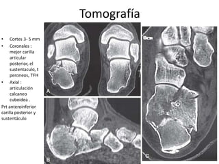 Tomografía
• Cortes 3- 5 mm
• Coronales :
mejor carilla
articular
posterior, el
sustentaculo, t
peroneos, TFH
• Axial :
articulación
calcaneo
cuboidea .
Prt anteroinferior
carilla posterior y
sustentáculo
 