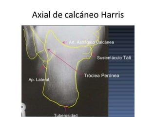 Axial de calcáneo Harris
 