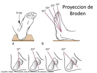 Proyeccion de
Broden
Coughlin, Mann . Pie y tobillo, Cap 38 Fracturas de calcaneo. Marban
 