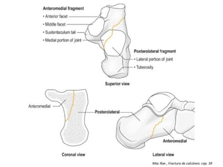 Mac Rae , Fractura de calcáneo. cap. 39
 