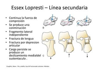 • Continua la fuerza de
compresión
• Se produce una
conminución
• Fragmento lateral
independiente
• Fractura de lengua
• Fractura por depresion
articular
• Carga persiste se
produce un
deslizamiento medialdel
sustentaculo .
Essex Lopresti – Línea secundaria
Coughlin, Mann . Pie y tobillo, Cap 38 Fracturasde calcáneo. Marban
 