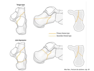Mac Rae , Fractura de calcáneo. cap. 39
 