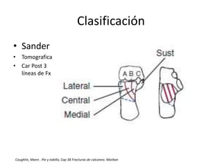 Clasificación
• Sander
• Tomografica
• Car Post 3
líneas de Fx
Coughlin, Mann . Pie y tobillo, Cap 38 Fracturas de calcaneo. Marban
 