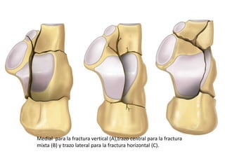 Medial para la fractura vertical (A),trazo central para la fractura
mixta (B) y trazo lateral para la fractura horizontal (C).
 