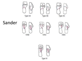 Sander
 