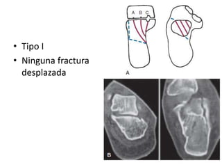 • Tipo I
• Ninguna fractura
desplazada
 