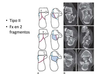 • Tipo II
• Fx en 2
fragmentos
 