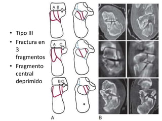 • Tipo III
• Fractura en
3
fragmentos
• Fragmento
central
deprimido
 