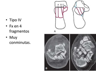 • Tipo IV
• Fx en 4
fragmentos
• Muy
conminutas.
 