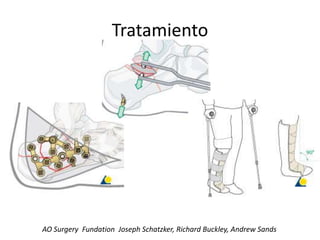 Tratamiento
AO Surgery Fundation Joseph Schatzker, Richard Buckley, Andrew Sands
 