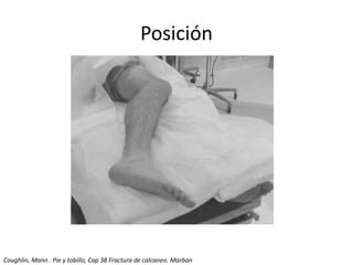 Posición
Coughlin, Mann . Pie y tobillo, Cap 38 Fractura de calcaneo. Marban
 