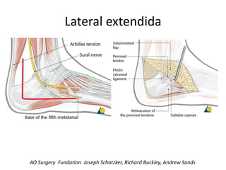 Lateral extendida
AO Surgery Fundation Joseph Schatzker, Richard Buckley, Andrew Sands
 