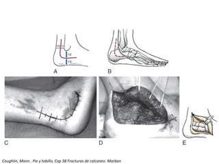 Coughlin, Mann . Pie y tobillo, Cap 38 Fracturas de calcaneo. Marban
 