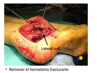 • Remover el hematoma fracturarlo
 