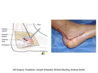 AO Surgery Fundation Joseph Schatzker, Richard Buckley, Andrew Sands
 