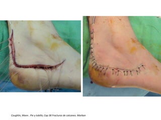 Coughlin, Mann . Pie y tobillo, Cap 38 Fracturas de calcaneo. Marban
 