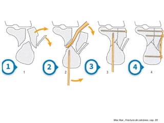 Mac Rae , Fractura de calcáneo. cap. 39
 