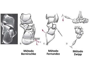 Método
Bernirschke
Método
Fernandez
Método
Zwipp
 