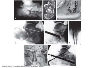 Coughlin, Mann . Pie y tobillo, Cap 38 Fractura de calcáneo. Marban
 