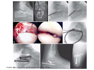 Coughlin, Mann . Pie y tobillo, Cap 38 Fracturas de calcaneo. Marban
 