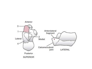 Fractura de calcaneo