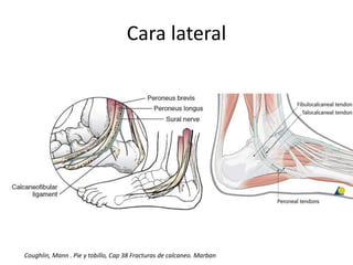 Cara lateral
Coughlin, Mann . Pie y tobillo, Cap 38 Fracturas de calcaneo. Marban
 