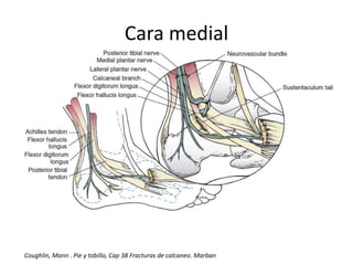 Cara medial
Coughlin, Mann . Pie y tobillo, Cap 38 Fracturas de calcaneo. Marban
 