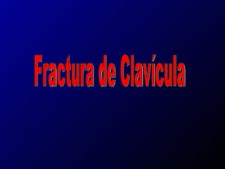 Fractura de Clavícula 