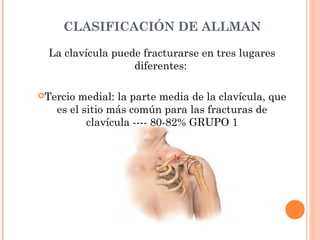 CLASIFICACIÓN DE ALLMAN

  La clavícula puede fracturarse en tres lugares
                   diferentes:

Tercio medial: la parte media de la clavícula, que
   es el sitio más común para las fracturas de
          clavícula ---- 80-82% GRUPO 1
 