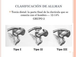 CLASIFICACIÓN DE ALLMAN
   Tercio distal: la parte final de la clavícula que se
            conecta con el hombro---- 12-14%
                        GRUPO 2
 