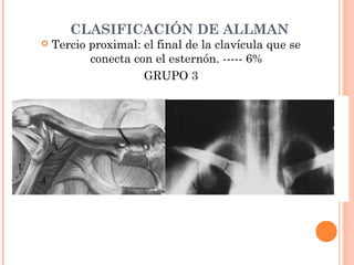 CLASIFICACIÓN DE ALLMAN
   Tercio proximal: el final de la clavícula que se
           conecta con el esternón. ----- 6%
                     GRUPO 3
 