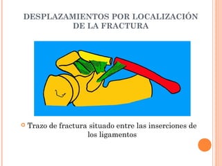 DESPLAZAMIENTOS POR LOCALIZACIÓN
         DE LA FRACTURA




   Trazo de fractura situado entre las inserciones de
                     los ligamentos
 