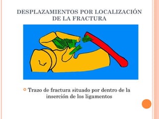 DESPLAZAMIENTOS POR LOCALIZACIÓN
         DE LA FRACTURA




    Trazo de fractura situado por dentro de la
            inserción de los ligamentos
 