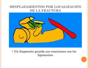 DESPLAZAMIENTOS POR LOCALIZACIÓN
         DE LA FRACTURA




   Un fragmento guarda sus conexiones con los
                   ligamentos
 