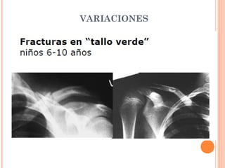 VARIACIONES
 