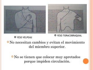  YESO TORACOBRAQUIAL
    YESO VELPEAU

 No   necesitan cambios y evitan el movimiento
               del miembro superior.

   No   se tienen que colocar muy apretados
            porque impiden circulación.
 