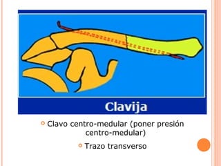    Clavo centro-medular (poner presión
              centro-medular)
              Trazo transverso
 
