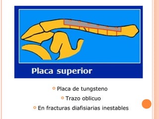    Placa de tungsteno
                 Trazo oblicuo
   En fracturas diafisiarias inestables
 