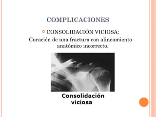 COMPLICACIONES
      CONSOLIDACIÓN VICIOSA:
Curación de una fractura con alineamiento
           anatómico incorrecto.
 