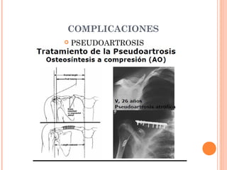 COMPLICACIONES
   PSEUDOARTROSIS
 