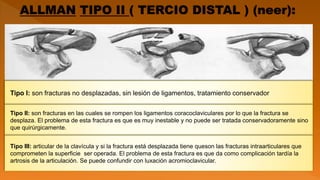 Tipo I: son fracturas no desplazadas, sin lesión de ligamentos, tratamiento conservador
Tipo II: son fracturas en las cuales se rompen los ligamentos coracoclaviculares por lo que la fractura se
desplaza. El problema de esta fractura es que es muy inestable y no puede ser tratada conservadoramente sino
que quirúrgicamente.
Tipo III: articular de la clavícula y si la fractura está desplazada tiene queson las fracturas intraarticulares que
comprometen la superficie ser operada. El problema de esta fractura es que da como complicación tardía la
artrosis de la articulación. Se puede confundir con luxación acromioclavicular.
 
