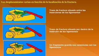Trazo de fractura situado entre las
inserciones de los ligamentos
Trazo de fractura situado por dentro de la
inserción de los ligamentos
Un fragmento guarda sus conexiones con los
ligamentos
Los desplazamientos varían en función de la localización de la fractura.
 