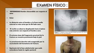 INSPECCIÓN :
 DEFORMIDAD:Hombro descendido con respecto al
sano.
 Dolor
 La distancia entre el hombro y la línea medio
esternal es más corta que la del lado sano.
 El muñón se observa desplazado hacia el plano
más anterior con respecto al hombro sano.
 El extremo óseo del fragmento proximal de la
fractura se muestra prominente bajo la piel.
 La prominencia descrita está exagerada por la
acumulación del hematoma de fractura.
 Equimosis de la fosa subclavicular que suele
extenderse hasta la región pectoral.
 