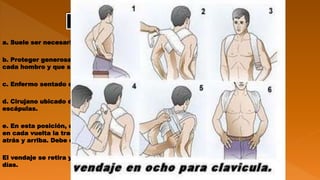 a. Suele ser necesario anestesia focal.
b. Proteger generosamente con almohadillado de algodón la cara anterior de
cada hombro y que se extiende al hueco axilar.
c. Enfermo sentado en un taburete.
d. Cirujano ubicado detrás del enfermo, y coloca una rodilla entre sus
escápulas.
e. En esta posición, coloca vendaje en ocho, cruzándolo entre las escápulas;
en cada vuelta la tracción ejercida por la venda debe llevar los hombros hacia
atrás y arriba. Debe cuidarse de no comprimir los vasos axilares.
El vendaje se retira y se vuelve a colocar, conservando la tracción, cada 3 a 5
días.
VENDAJE "EN OCHO
 