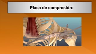 Fractura de clavicula