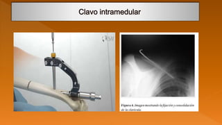 Fractura de clavicula