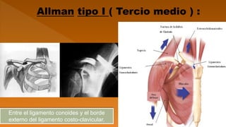 Entre el ligamento conoides y el borde
externo del ligamento costo-clavicular.
 