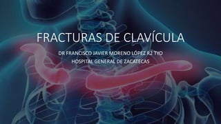 FRACTURAS DE CLAVÍCULA
DR FRANCISCO JAVIER MORENO LÓPEZ R2 TYO
HOSPITAL GENERAL DE ZACATECAS
 